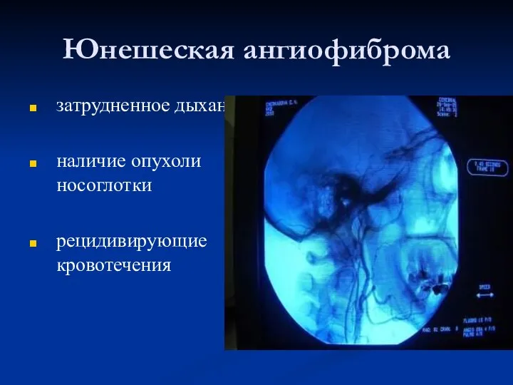 Юнешеская ангиофиброма затрудненное дыхание наличие опухоли носоглотки рецидивирующие кровотечения