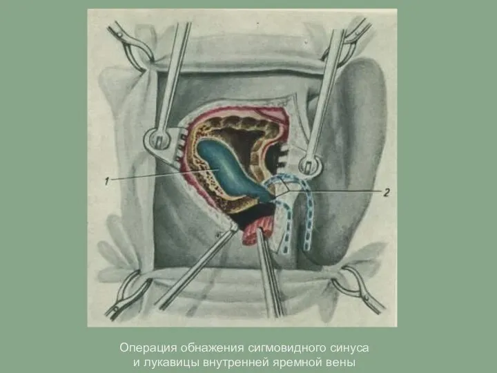 Операция обнажения сигмовидного синуса и лукавицы внутренней яремной вены Операция обнажения