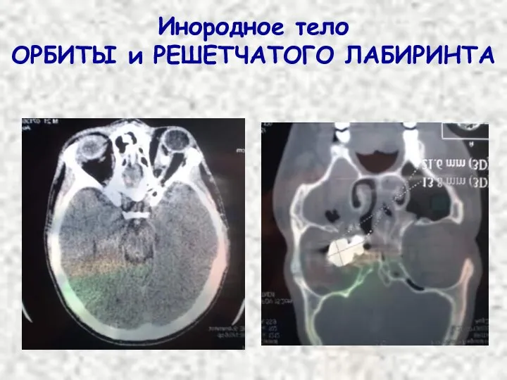 Инородное тело ОРБИТЫ и РЕШЕТЧАТОГО ЛАБИРИНТА