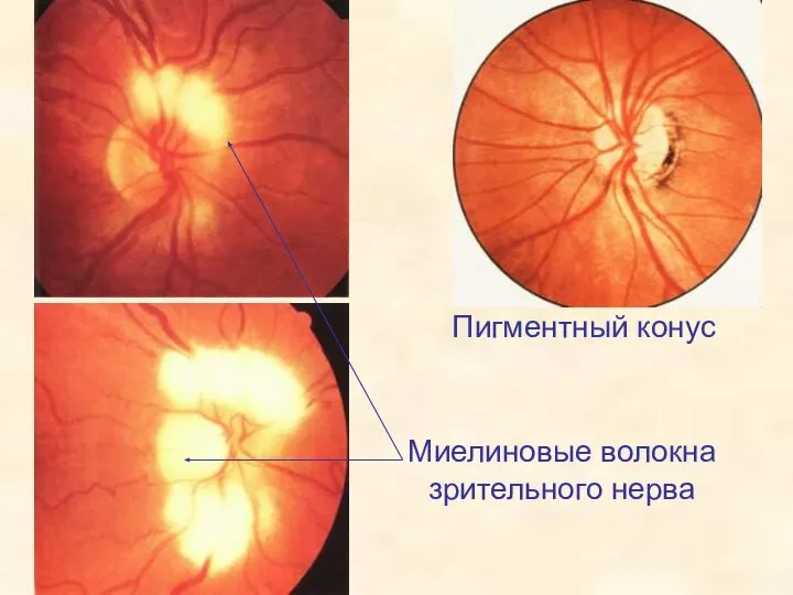 Миелиновые волокна зрительного нерва Пигментный конус