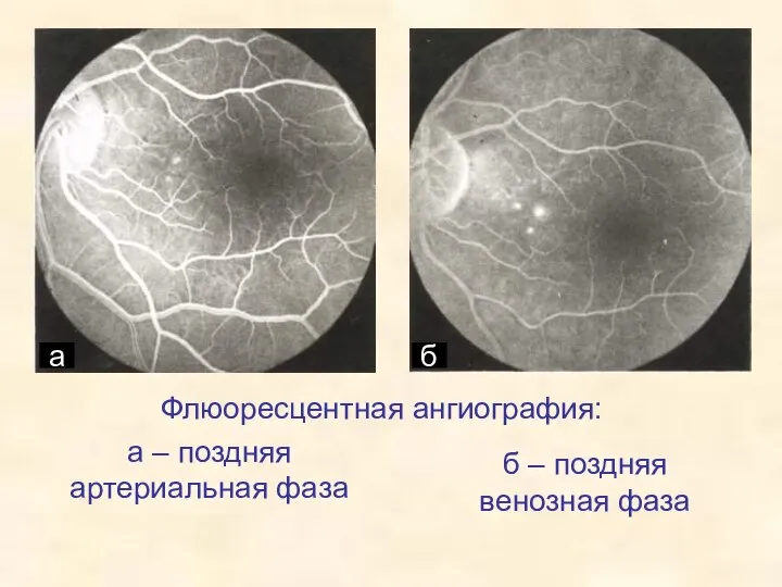 Флюоресцентная ангиография: а – поздняя артериальная фаза б – поздняя венозная фаза а б