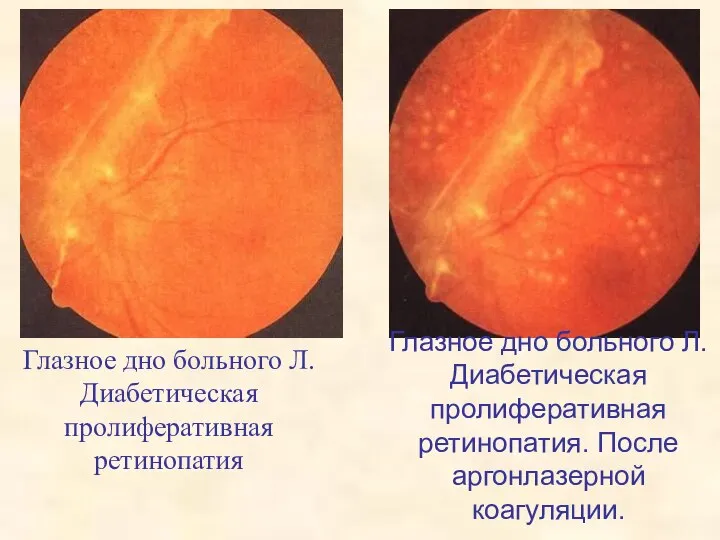 Глазное дно больного Л. Диабетическая пролиферативная ретинопатия Глазное дно больного Л.