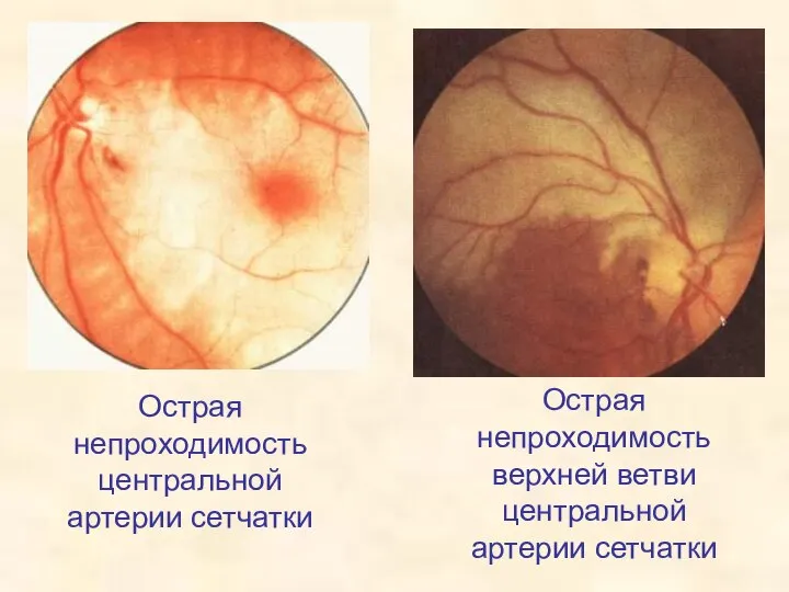 Острая непроходимость центральной артерии сетчатки Острая непроходимость верхней ветви центральной артерии сетчатки