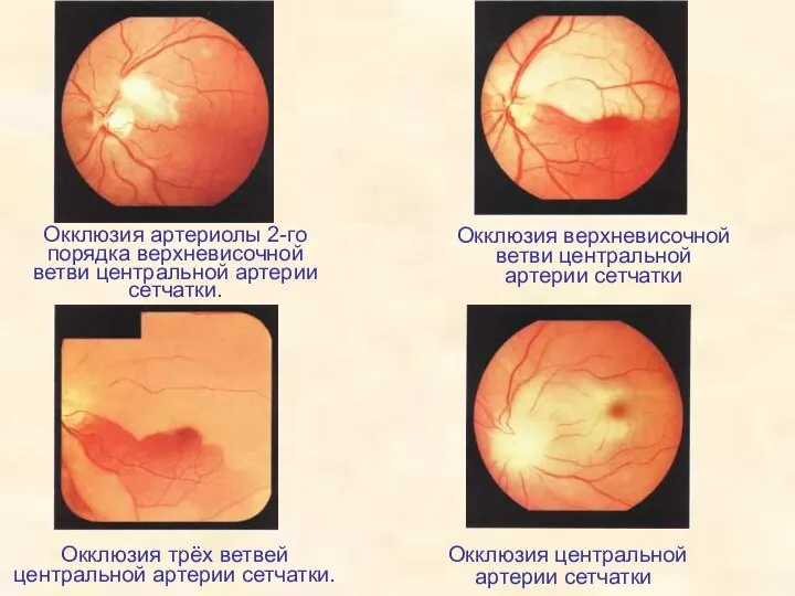 Окклюзия артериолы 2-го порядка верхневисочной ветви центральной артерии сетчатки. Окклюзия верхневисочной