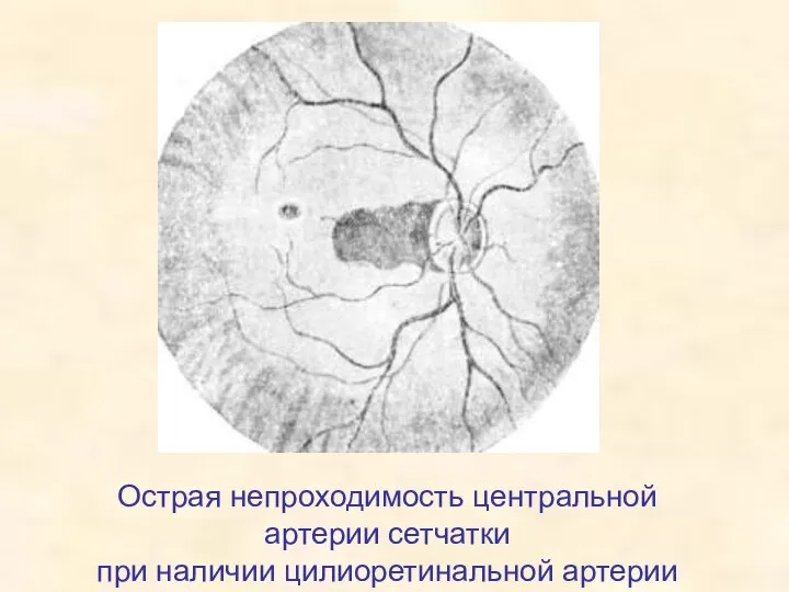 Острая непроходимость центральной артерии сетчатки при наличии цилиоретинальной артерии
