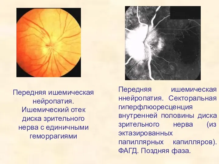 Передняя ишемическая нейропатия. Ишемический отек диска зрительного нерва с единичными геморрагиями
