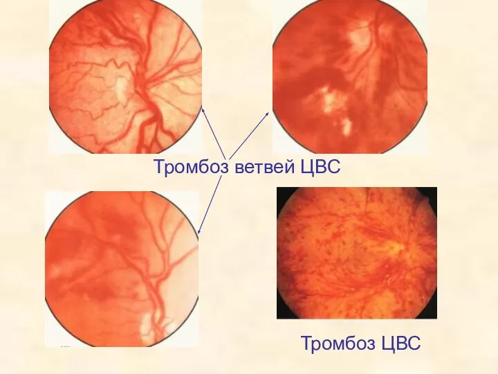 Тромбоз ветвей ЦВС Тромбоз ЦВС