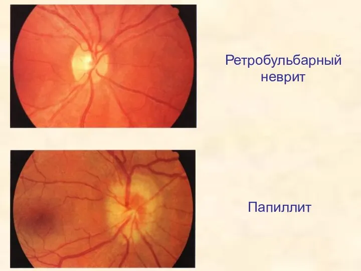 Ретробульбарный неврит Папиллит