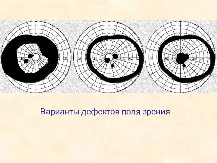 Варианты дефектов поля зрения