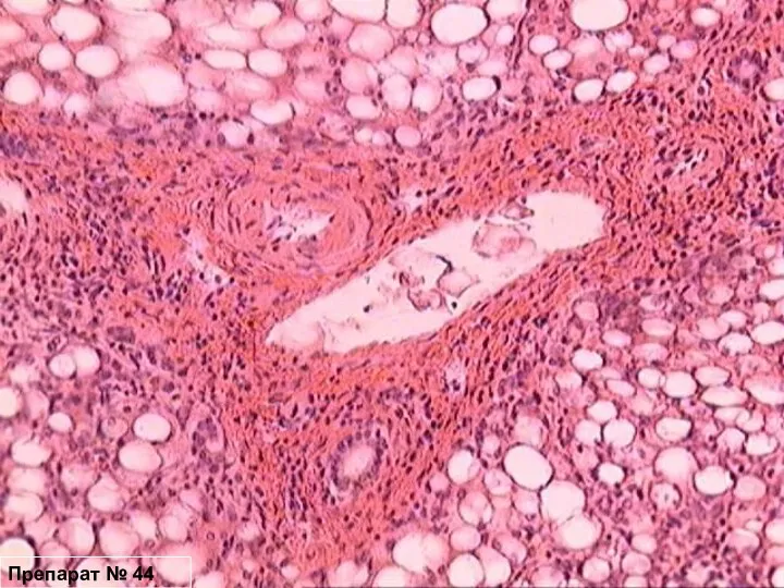 Препарат № 44