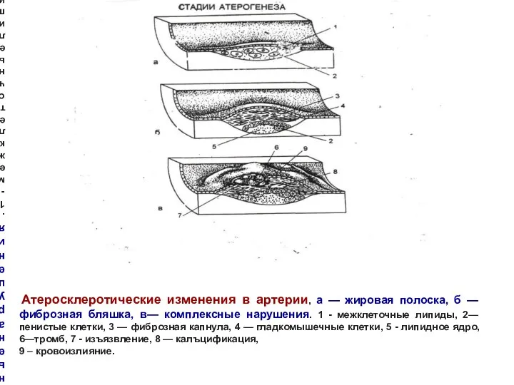 Атеросклеротические изменения в артерии, а — жировая полоска, б — фиброзная