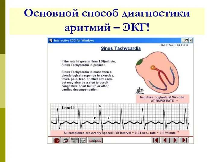 Основной способ диагностики аритмий – ЭКГ!