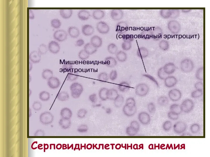 Серповидноклеточная анемия