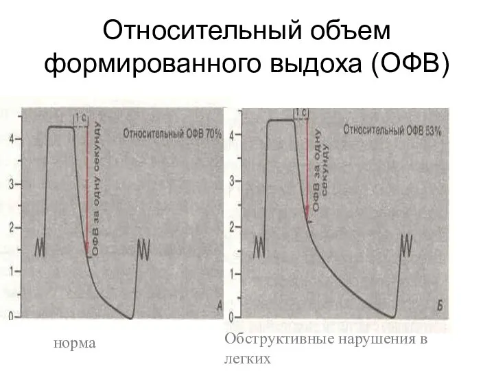 Относительный объем формированного выдоха (ОФВ) норма Обструктивные нарушения в легких