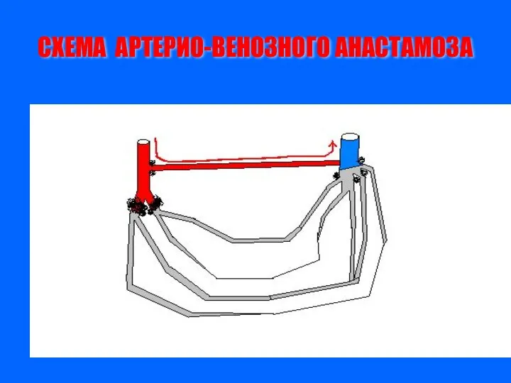 СХЕМА АРТЕРИО-ВЕНОЗНОГО АНАСТАМОЗА