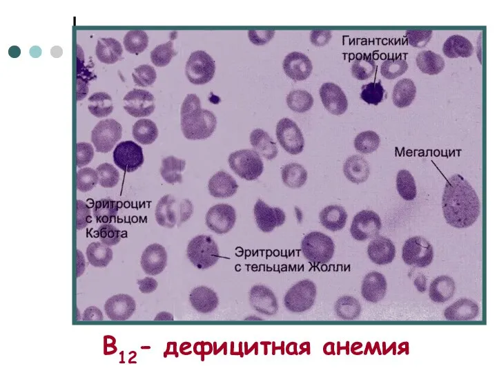 В12- дефицитная анемия