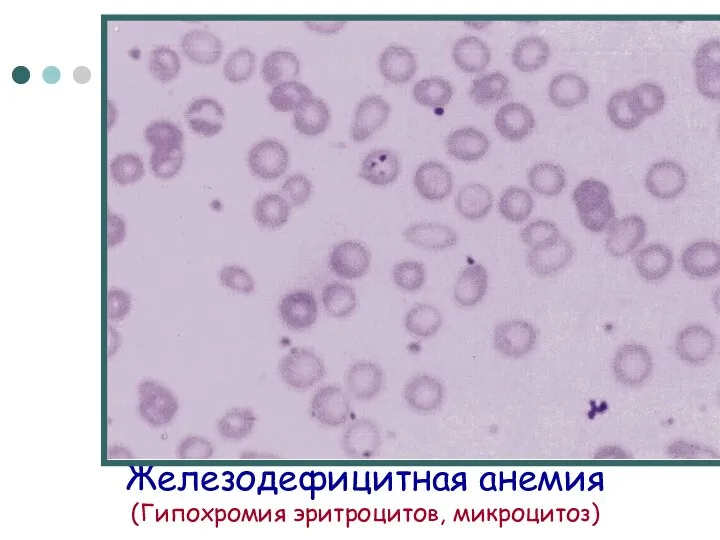 Железодефицитная анемия (Гипохромия эритроцитов, микроцитоз)