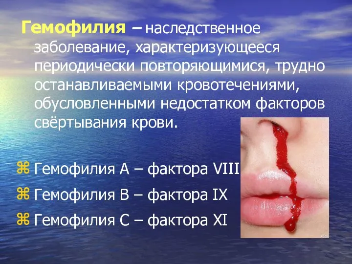 Гемофилия – наследственное заболевание, характеризующееся периодически повторяющимися, трудно останавливаемыми кровотечениями, обусловленными