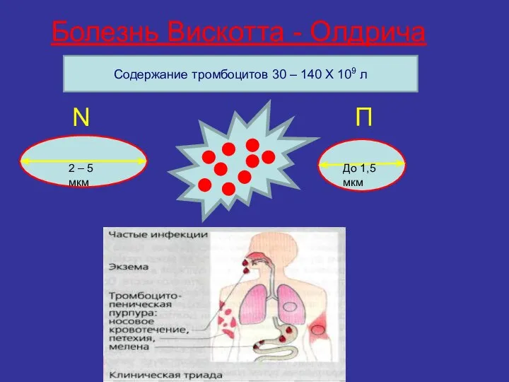 Болезнь Вискотта - Олдрича Содержание тромбоцитов 30 – 140 Х 109