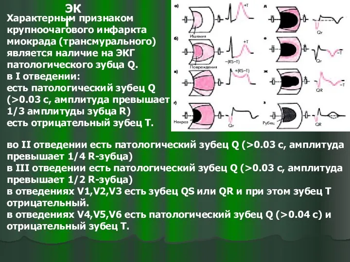 Характерным признаком крупноочагового инфаркта миокрада (трансмурального) является наличие на ЭКГ патологического