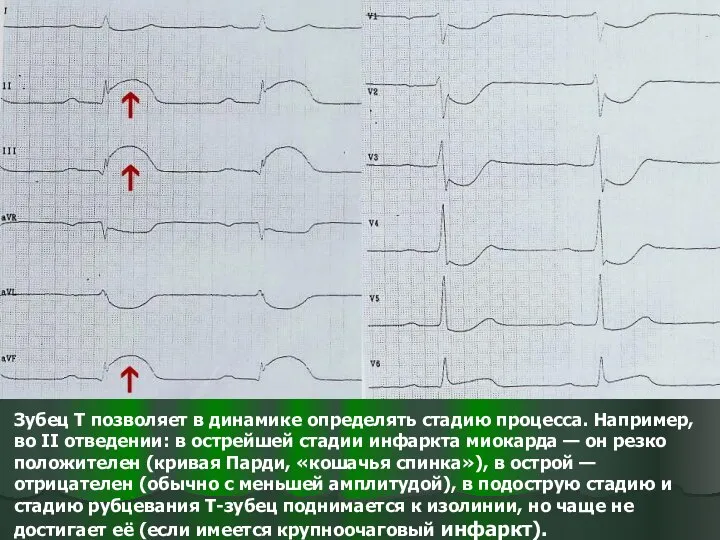 Зубец T позволяет в динамике определять стадию процесса. Например, во II