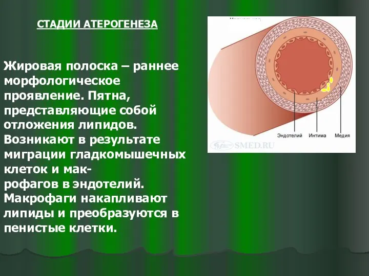 СТАДИИ АТЕРОГЕНЕЗА Жировая полоска – раннее морфологическое проявление. Пятна, представляющие собой