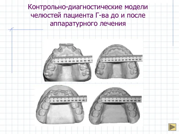 Контрольно-диагностические модели челюстей пациента Г-ва до и после аппаратурного лечения