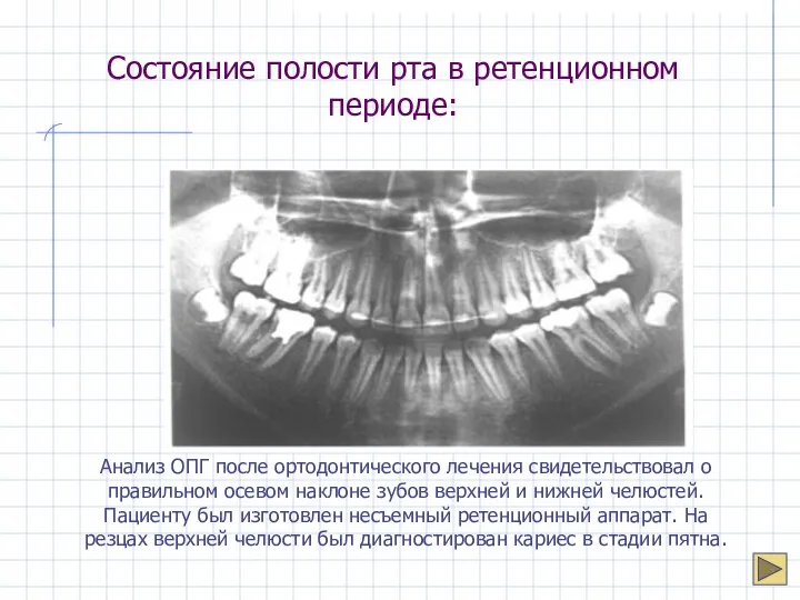 Состояние полости рта в ретенционном периоде: Анализ ОПГ после ортодонтического лечения