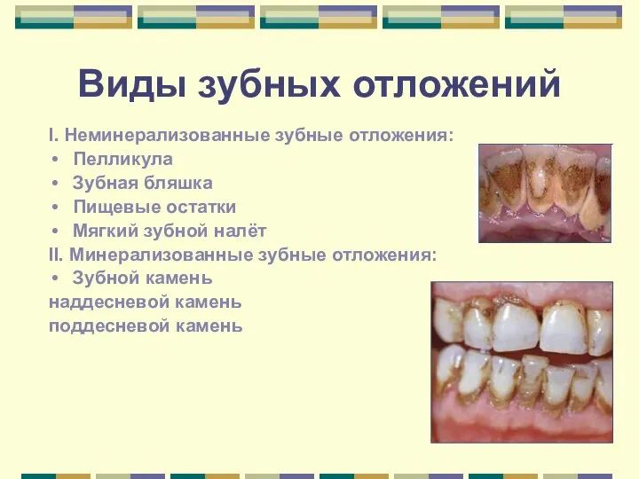 Виды зубных отложений I. Неминерализованные зубные отложения: Пелликула Зубная бляшка Пищевые