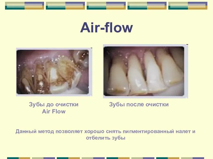 Air-flow Данный метод позволяет хорошо снять пигментированный налет и отбелить зубы