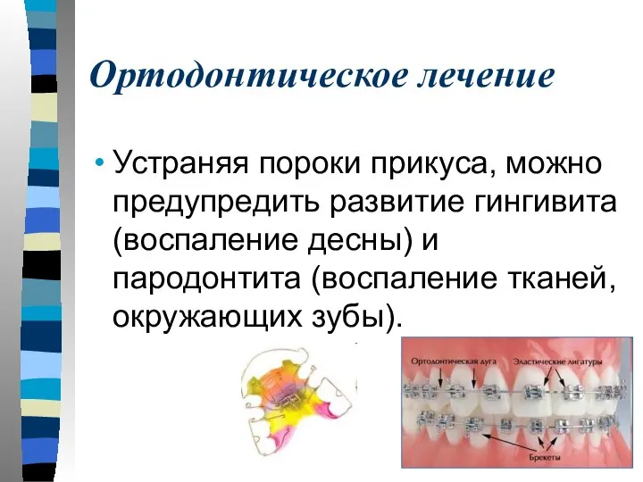 Ортодонтическое лечение Устраняя пороки прикуса, можно предупредить развитие гингивита (воспаление десны)