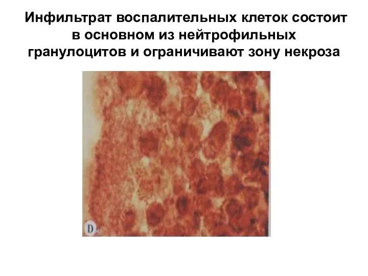 Инфильтрат воспалительных клеток состоит в основном из нейтрофильных гранулоцитов и ограничивают зону некроза