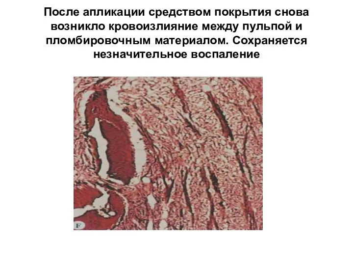 После апликации средством покрытия снова возникло кровоизлияние между пульпой и пломбировочным материалом. Сохраняется незначительное воспаление