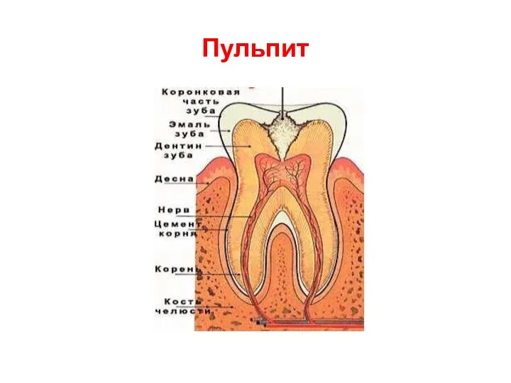 Пульпит