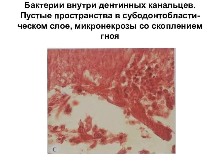 Бактерии внутри дентинных канальцев. Пустые пространства в субодонтобласти-ческом слое, микронекрозы со скоплением гноя