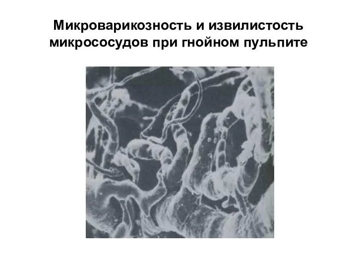 Микроварикозность и извилистость микрососудов при гнойном пульпите