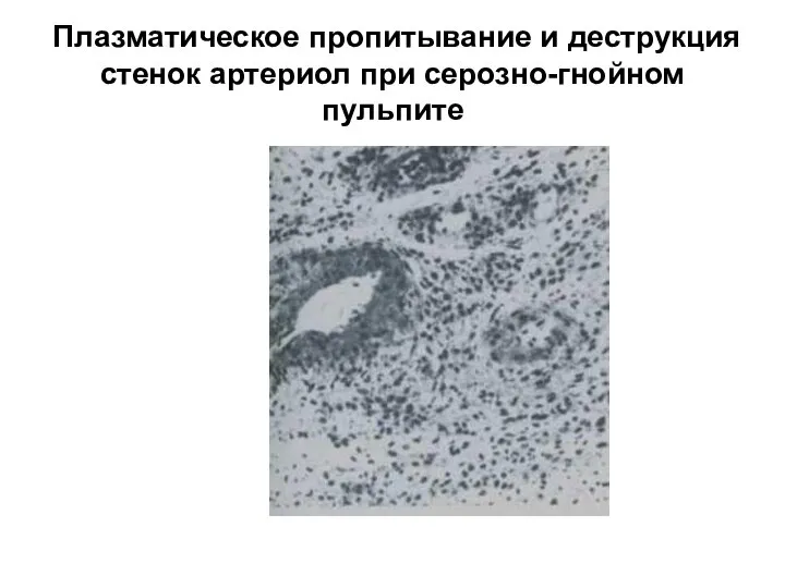 Плазматическое пропитывание и деструкция стенок артериол при серозно-гнойном пульпите