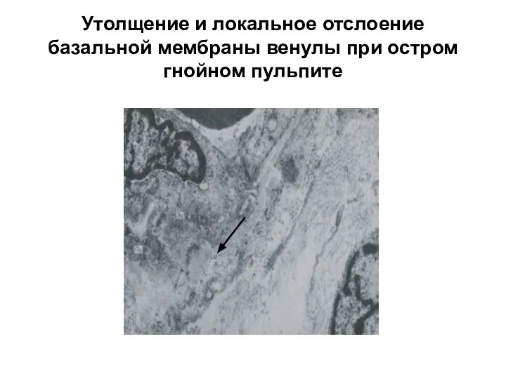 Утолщение и локальное отслоение базальной мембраны венулы при остром гнойном пульпите