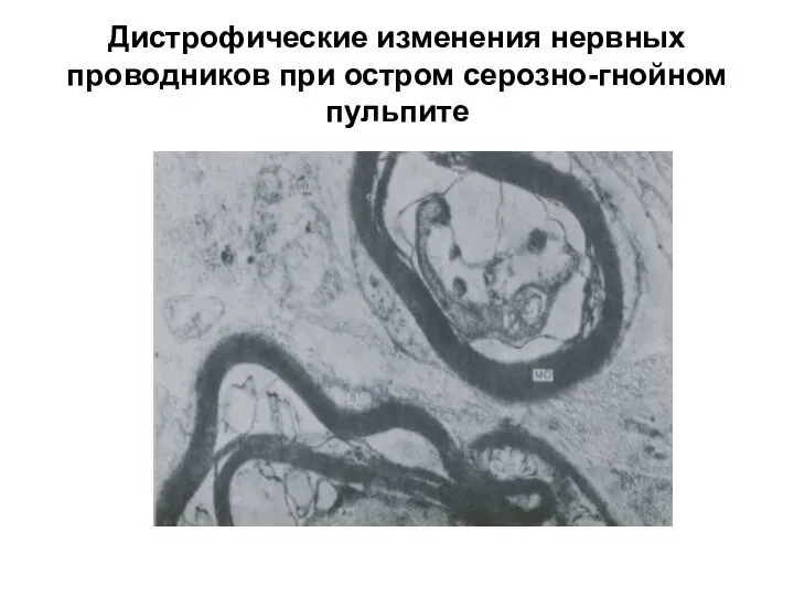 Дистрофические изменения нервных проводников при остром серозно-гнойном пульпите