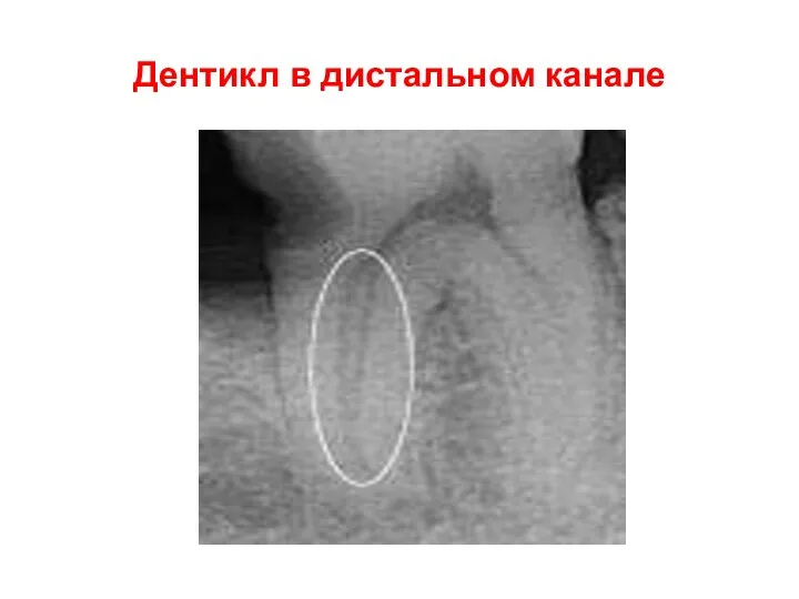 Дентикл в дистальном канале