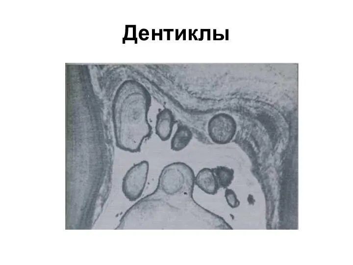 Дентиклы