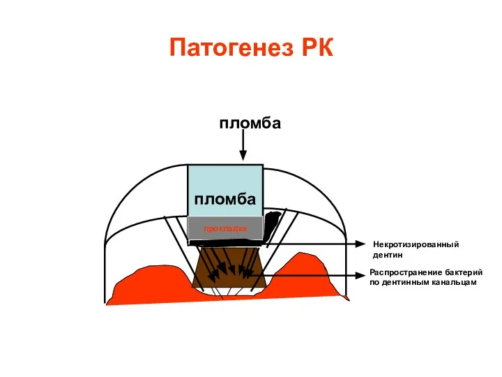 Патогенез РК пломба прокладка Некротизированный дентин пломба Распространение бактерий по дентинным канальцам