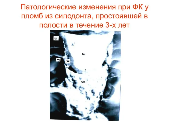 Патологические изменения при ФК у пломб из силодонта, простоявшей в полости в течение 3-х лет