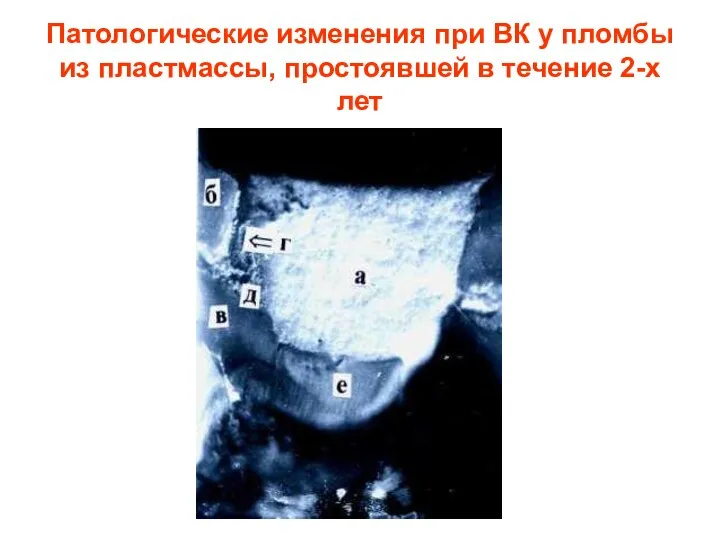 Патологические изменения при ВК у пломбы из пластмассы, простоявшей в течение 2-х лет