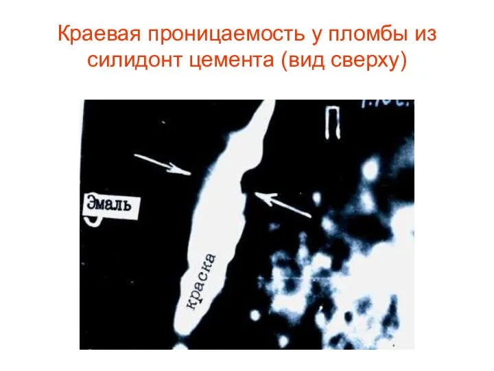 Краевая проницаемость у пломбы из силидонт цемента (вид сверху)