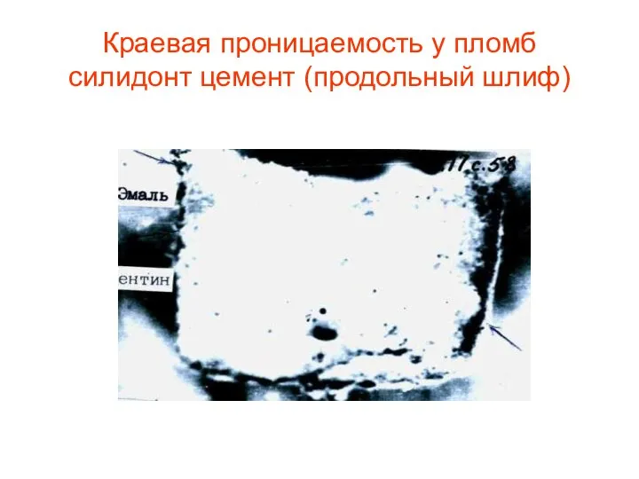 Краевая проницаемость у пломб силидонт цемент (продольный шлиф)