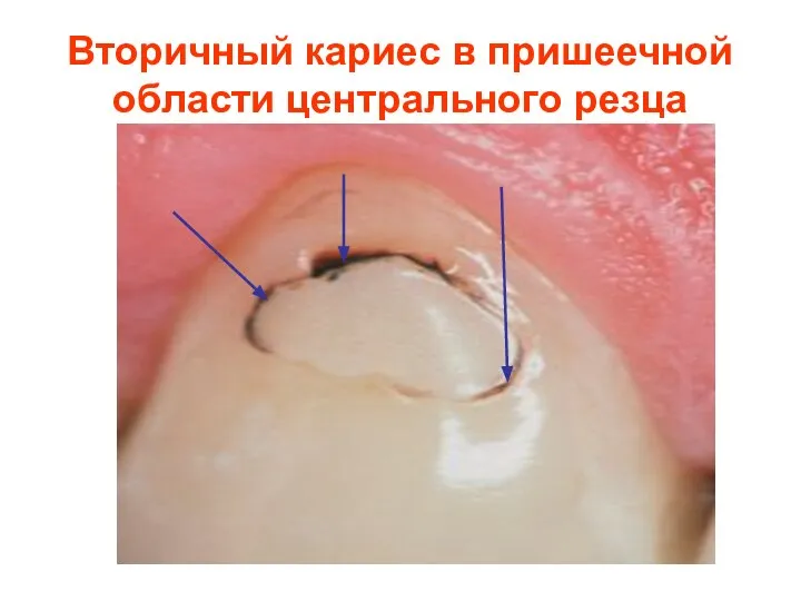 Вторичный кариес в пришеечной области центрального резца