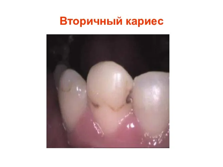 Вторичный кариес