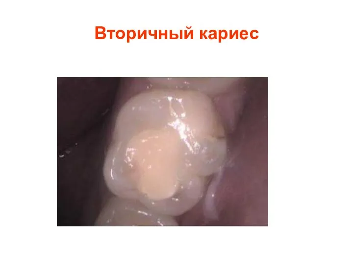 Вторичный кариес