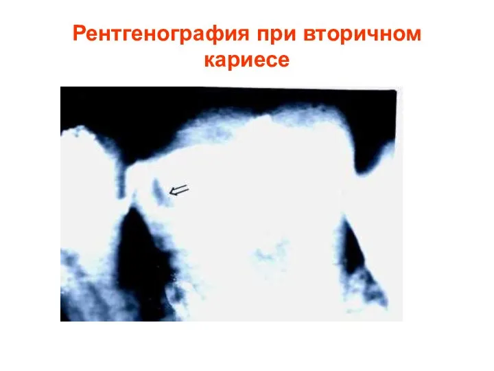 Рентгенография при вторичном кариесе